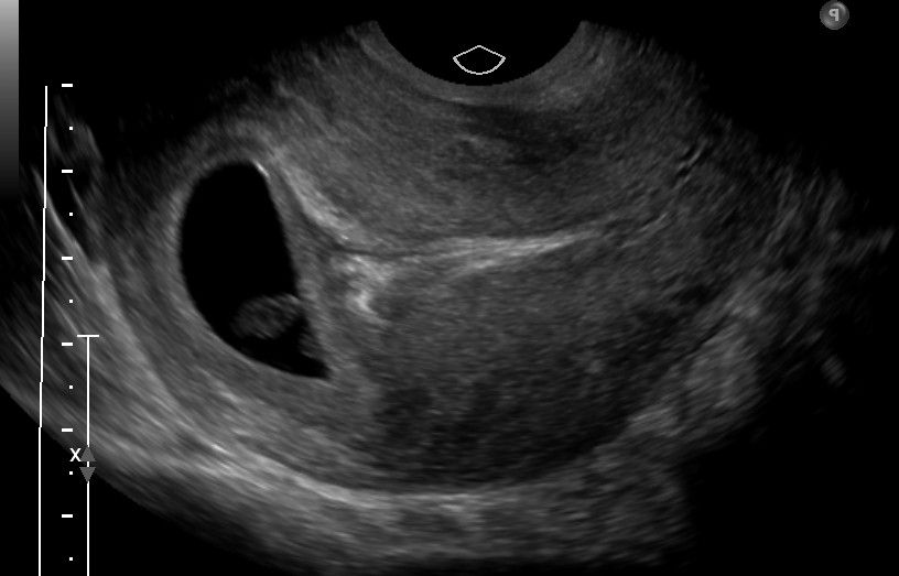 Radiological Evaluation of First Trimester Obstetrical Ultrasound